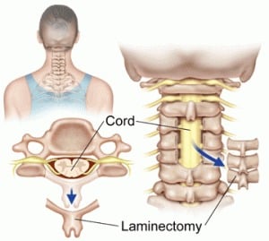 Lumbar Laminectomy diagram 0