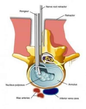 Micro Discectomy1 0 0 0