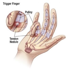 Trigger Finger Descriptive Image