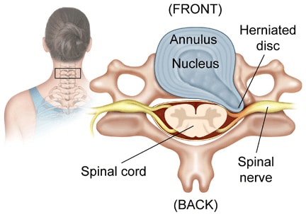 cervical disc herniation web