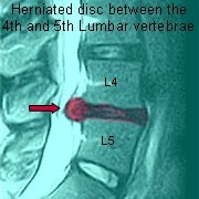 herniated disc 0