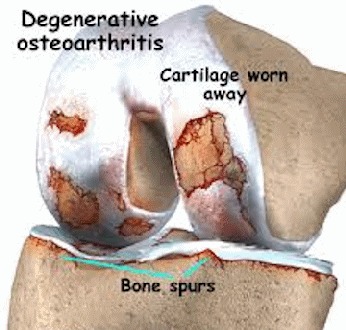knee 6 degenerative osteoarthrit