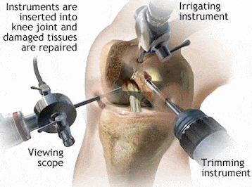 knee #16 arthroscopy.gif