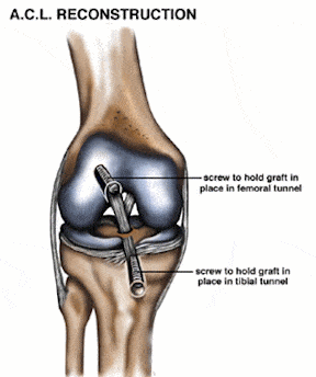 knee #17 ACL reconstruction.gif