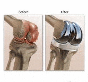 knee #8 knee replacement.gif