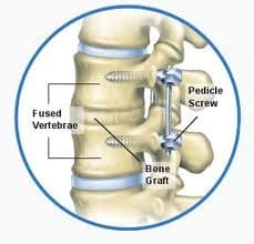 lumbar fusion3 0