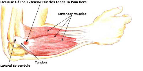 tennis elbow affected areas