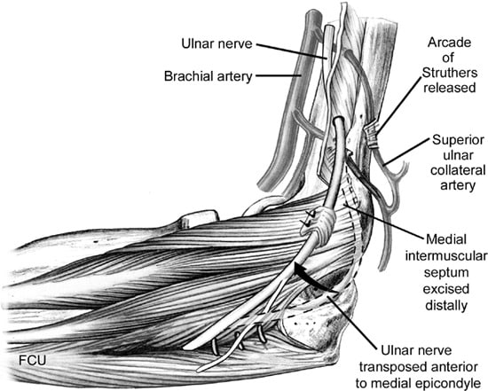 ulna nerve transposition diagram