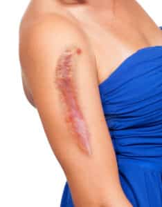 Woman in blue dress has large, prominent scar on her right arm following an injury that was not her fault